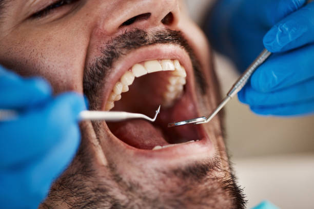 Best Emergency Dental Extractions in Los Osos, CA